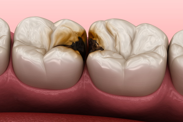 Molar teeth damaged by caries. Medically accurate tooth 3D illustration.