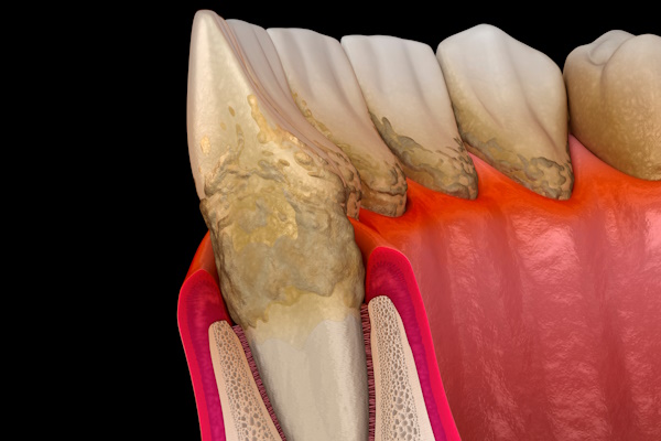 Periodontitis stage 1, gum recession, tartar. Medically accurate